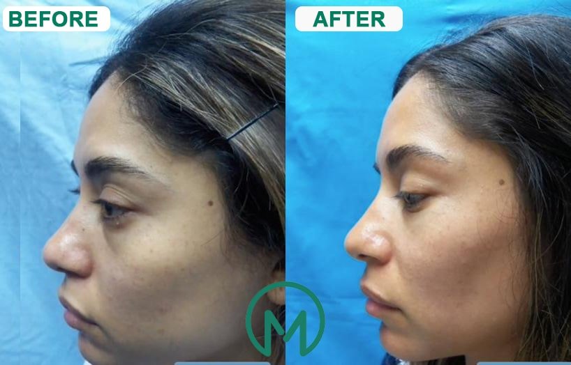 Rhinoplasty Nose Job In Istanbulturkey Cost And Reviews Meditravelist 