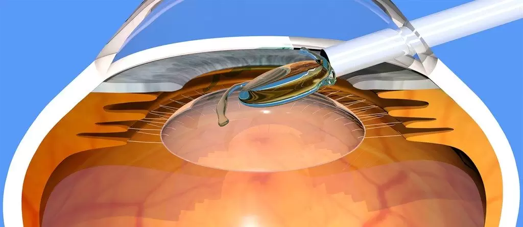 lens implantasyonu