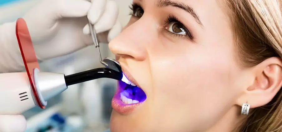 Dental bonding is a hardening procedure through a special light using a tooth-colored resin material on teeth surfaces