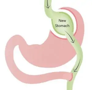 Gastricbypass schema