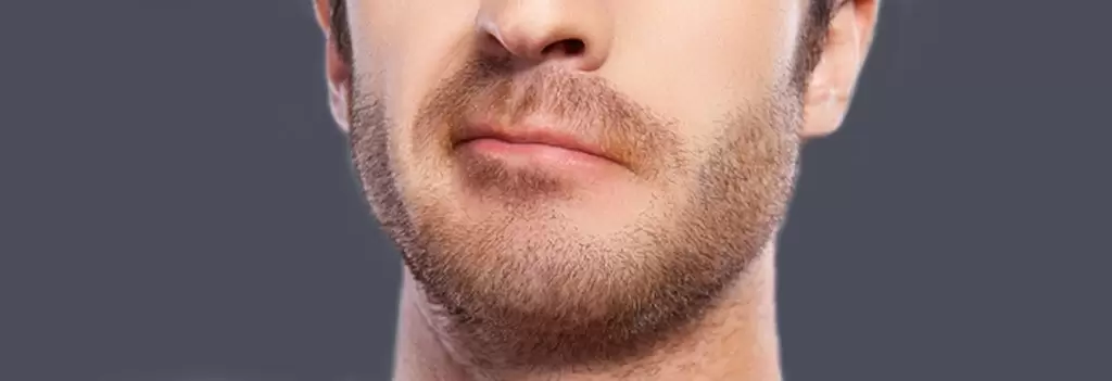 Beard And Moustache Transplantation title image