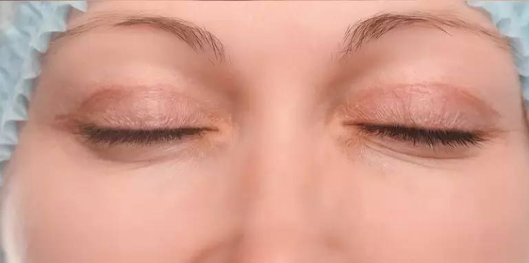 Meditravelist Eyelid Lift 1 2
