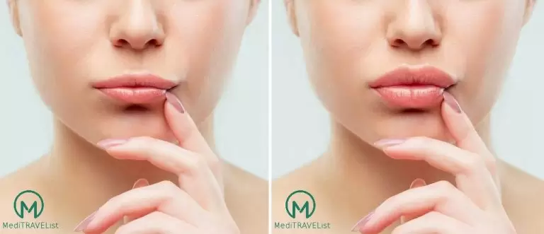 Meditravelist lip filling 1