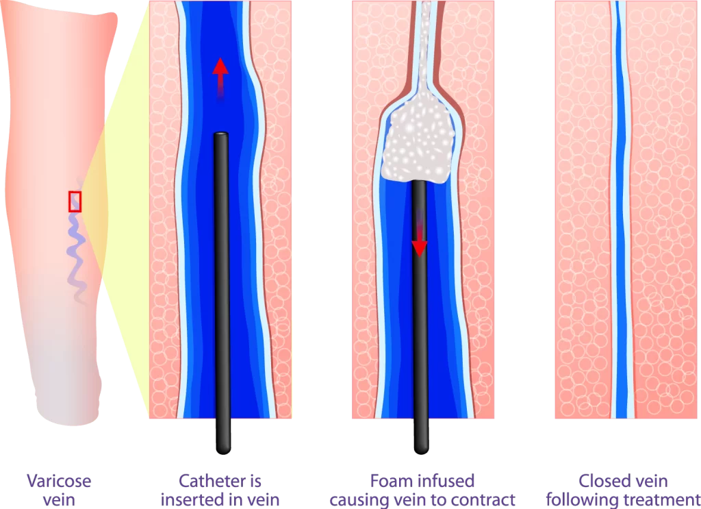 Sclerotherapy title image