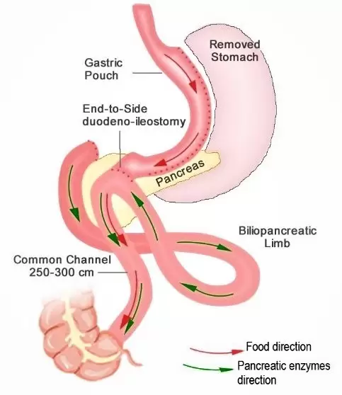 duodenal loop schematic image
