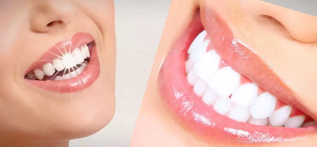 A method that uses zirconia veneer teeth for aesthetic smiles