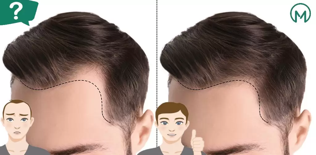 what is hair transplant title image