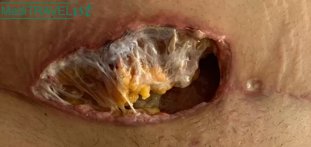 Fat necrosis after abdominoplasty surgery EN blog image