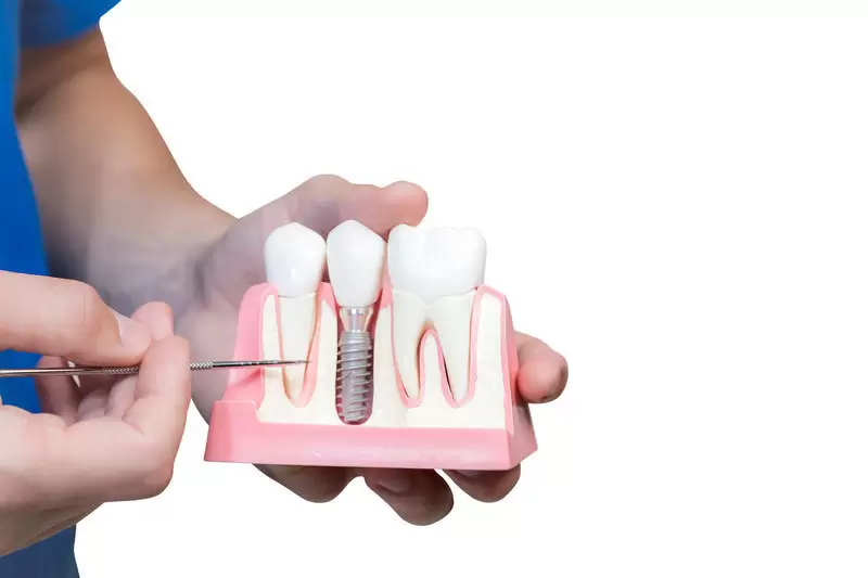 Dental implant model image