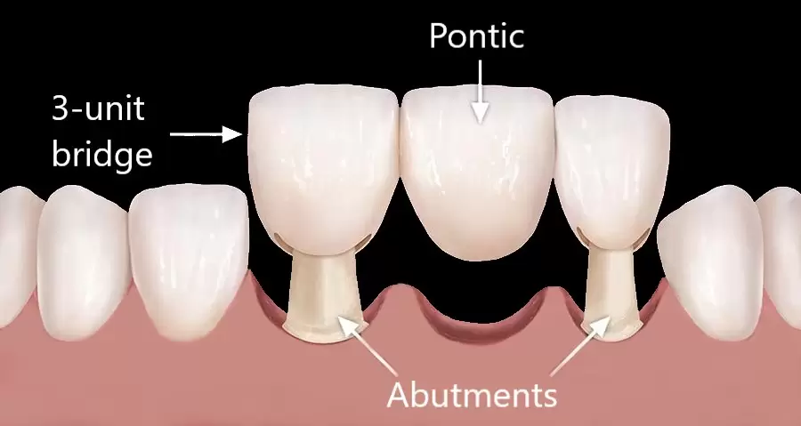 Dental bridge is a procedure which fills the gap with one or more false teeth