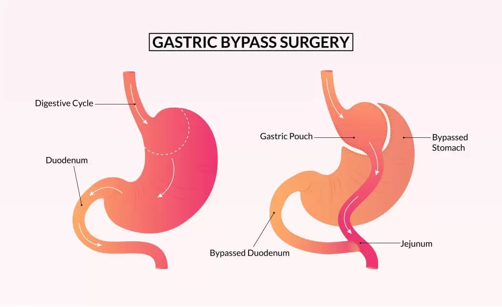 gastric bypass surgery min