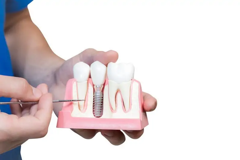 meditravelist dental implant model