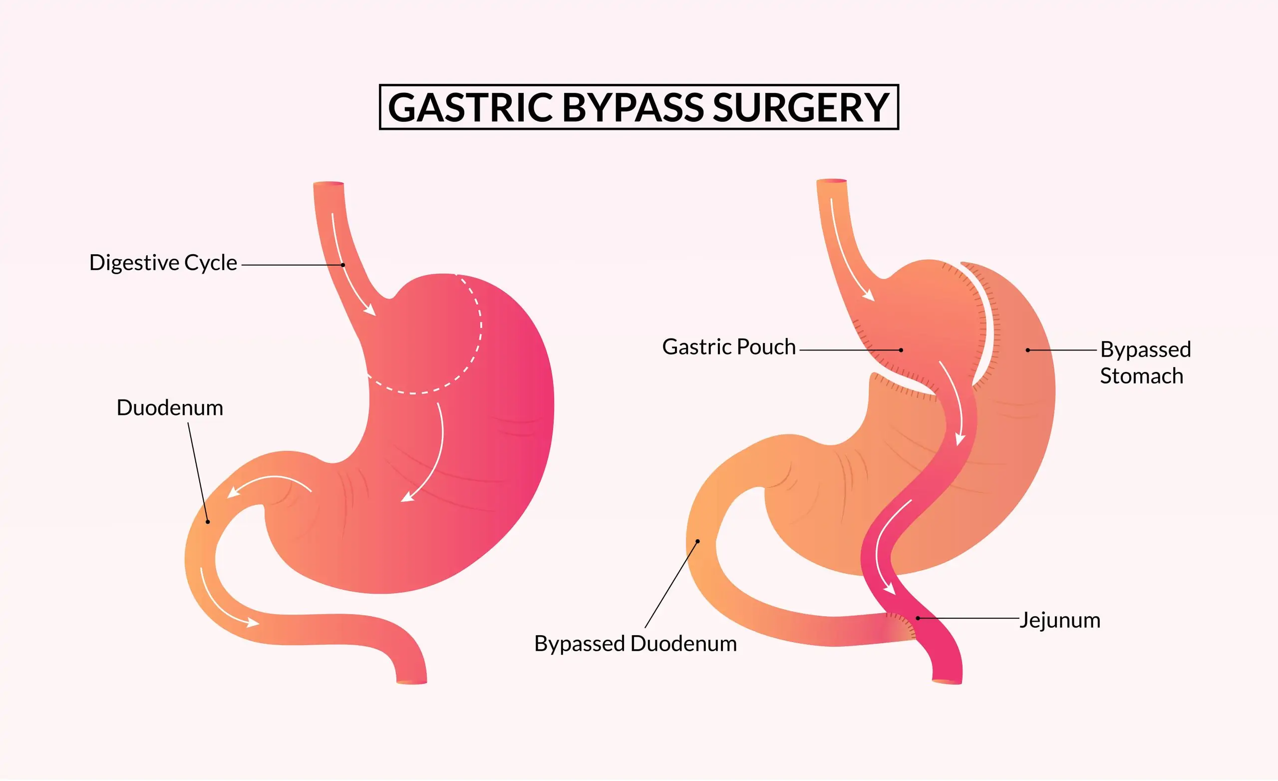 gastric bypass surgery min scaled