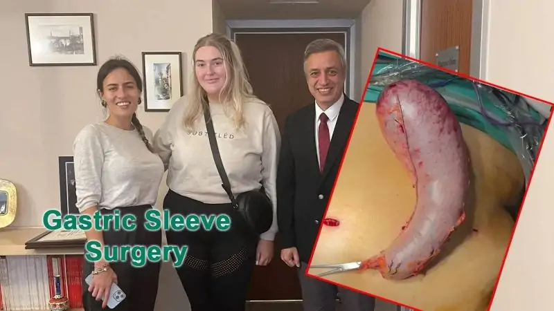 gastric sleeve surgery meditravelist e1696098614289