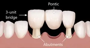 meditravelist dental bridges