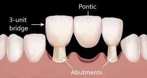 meditravelist dental bridges 1 1