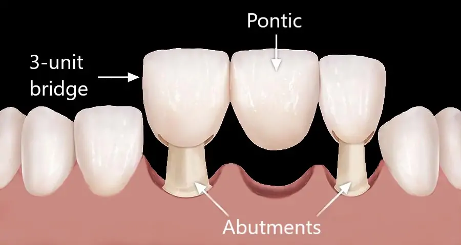 meditravelist dental bridges 1 2