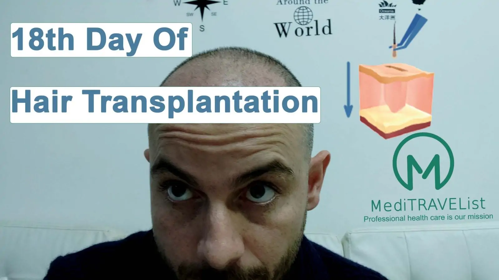 meditravelist samets 18th day of hairtransplantation 1