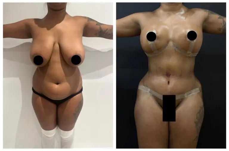 before-after-breast