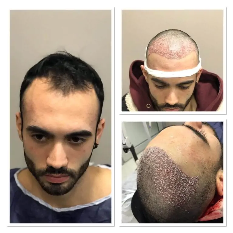 hair-transplant-before-after